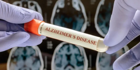 Alzheimer tanısında kan testleri dönemi