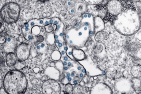 Parkinson Hastalığında Toksik Protein Birikimi Önleniyor