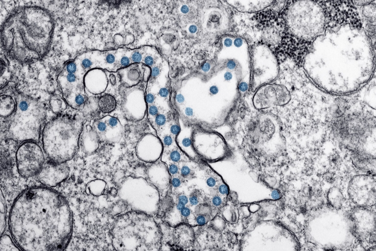 Parkinson Hastalığında Toksik Protein Birikimi Önleniyor