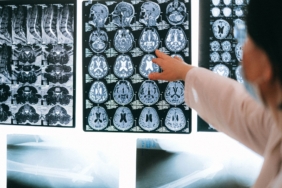 Alzheimer Hastalığı, Beyindeki Ritim Hücrelerini Etkiliyor