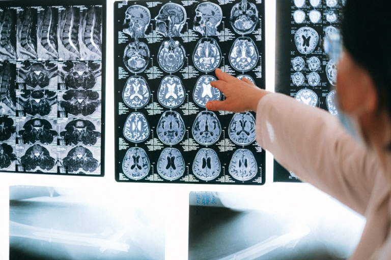 Alzheimer Hastalığı, Beyindeki Ritim Hücrelerini Etkiliyor