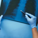 Küçük hücreli akciğer kanserinde immünoterapinin etkisi artıyor